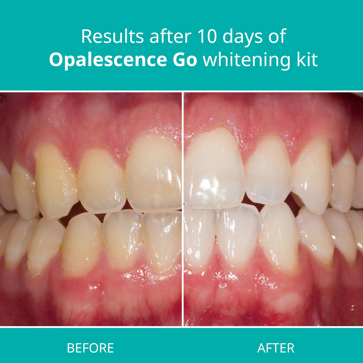 15% Hydrogen Peroxide Mint Prefilled Teeth Whitening Trays Q327111
