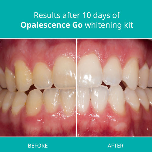 15% Hydrogen Peroxide Mint Prefilled Teeth Whitening Trays Q327111